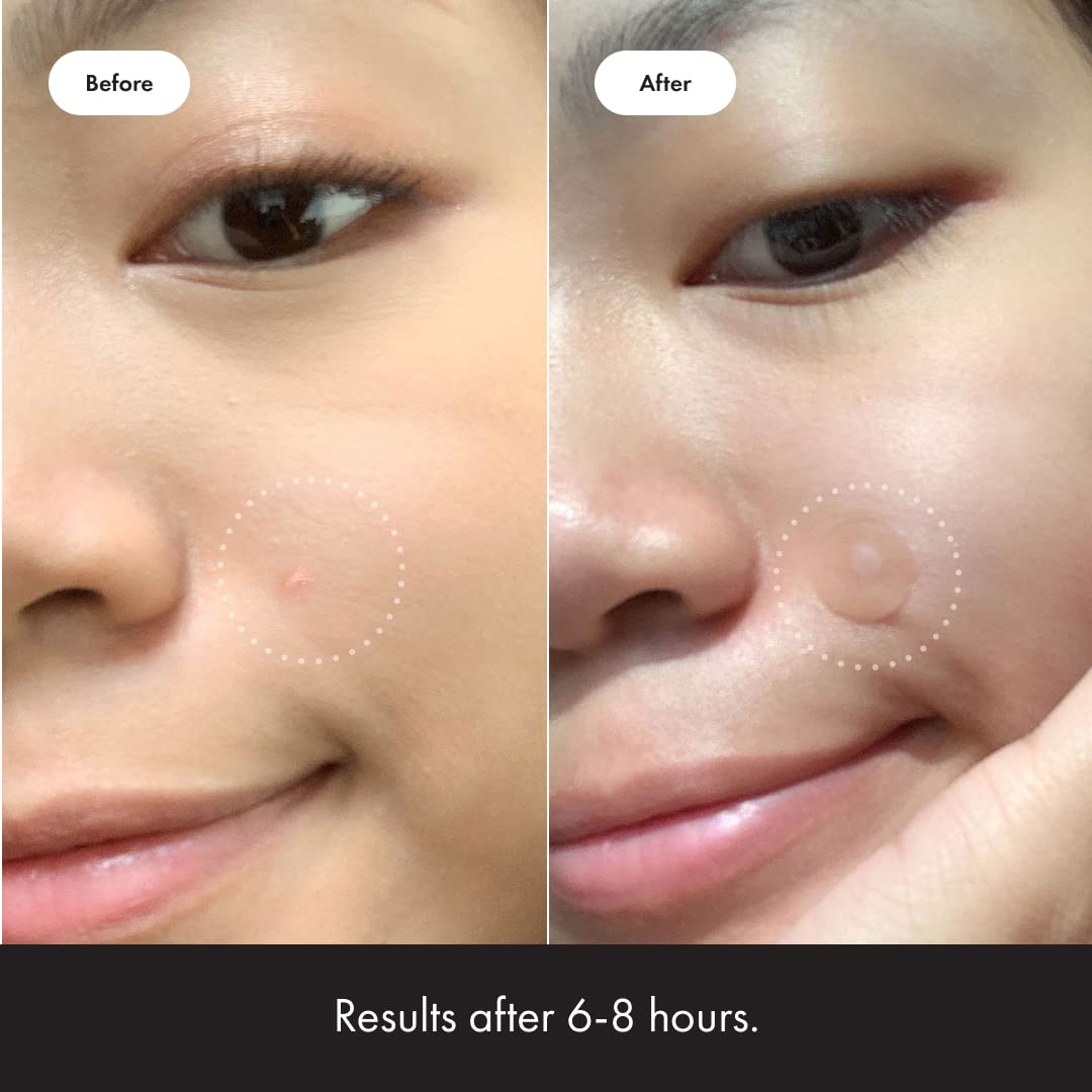 Mighty Patch™ Original – Hydrocolloid Acne Patches