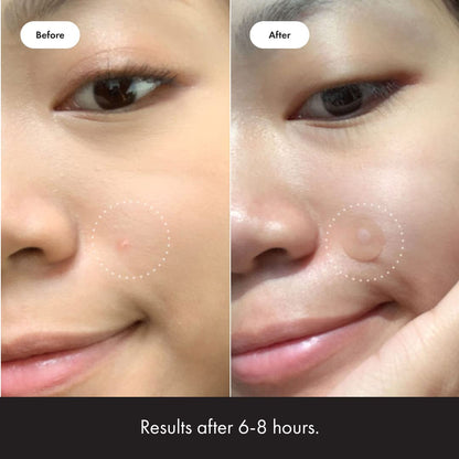 Mighty Patch™ Original – Hydrocolloid Acne Patches