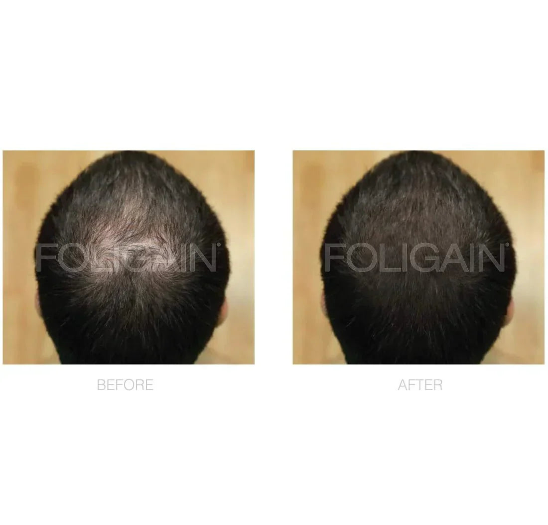 FOLIGAIN Minoxidil 5% Hair Regrowth Treatment For Men.